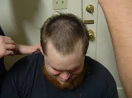 candidate for hair transplant-male pattern baldness image